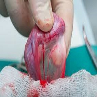 واریکوسل(Varicocele)